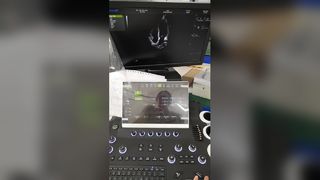 ระบบตรวจอัลตร้าซาวด์สี Doppler ของรถเข็น BR-US01