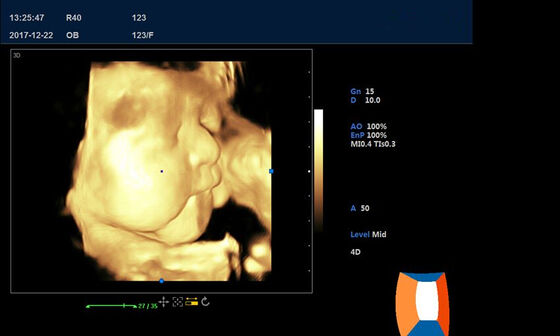Medical Ultrasound Device 4D Portable Color Doppler Machine